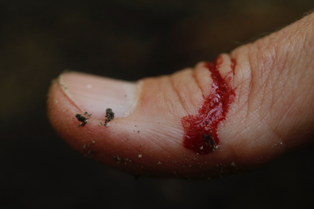13. I hurt myself today